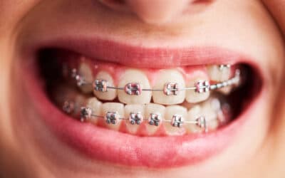 9 Signs Your Child Needs Braces | Kids Braces in Oradell